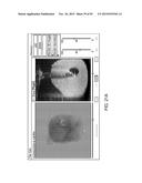 TISSUE RESECTION AND TREATMENT WITH SHEDDING PULSES diagram and image