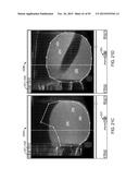 TISSUE RESECTION AND TREATMENT WITH SHEDDING PULSES diagram and image