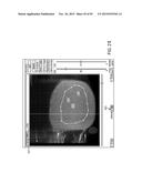 TISSUE RESECTION AND TREATMENT WITH SHEDDING PULSES diagram and image