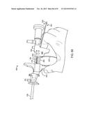 TISSUE RESECTION AND TREATMENT WITH SHEDDING PULSES diagram and image