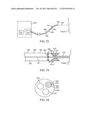 TISSUE RESECTION AND TREATMENT WITH SHEDDING PULSES diagram and image