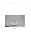 TISSUE RESECTION AND TREATMENT WITH SHEDDING PULSES diagram and image