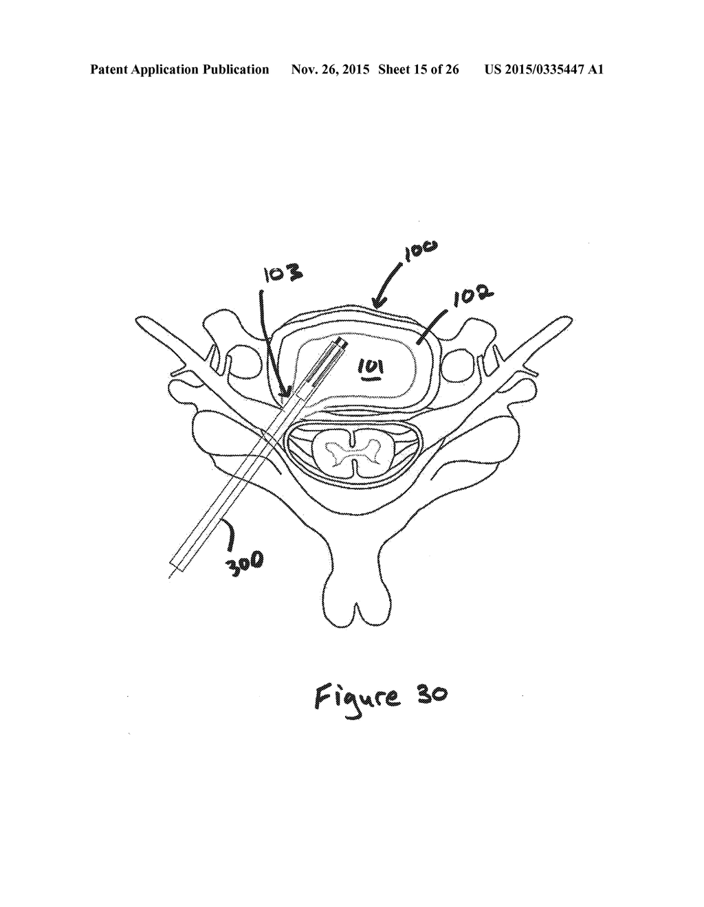 Devices and Methods for Treating Tissue Defects - diagram, schematic, and image 16