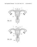 INTRAUTERINE CONTRACEPTIVE DEVICE diagram and image