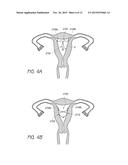 INTRAUTERINE CONTRACEPTIVE DEVICE diagram and image