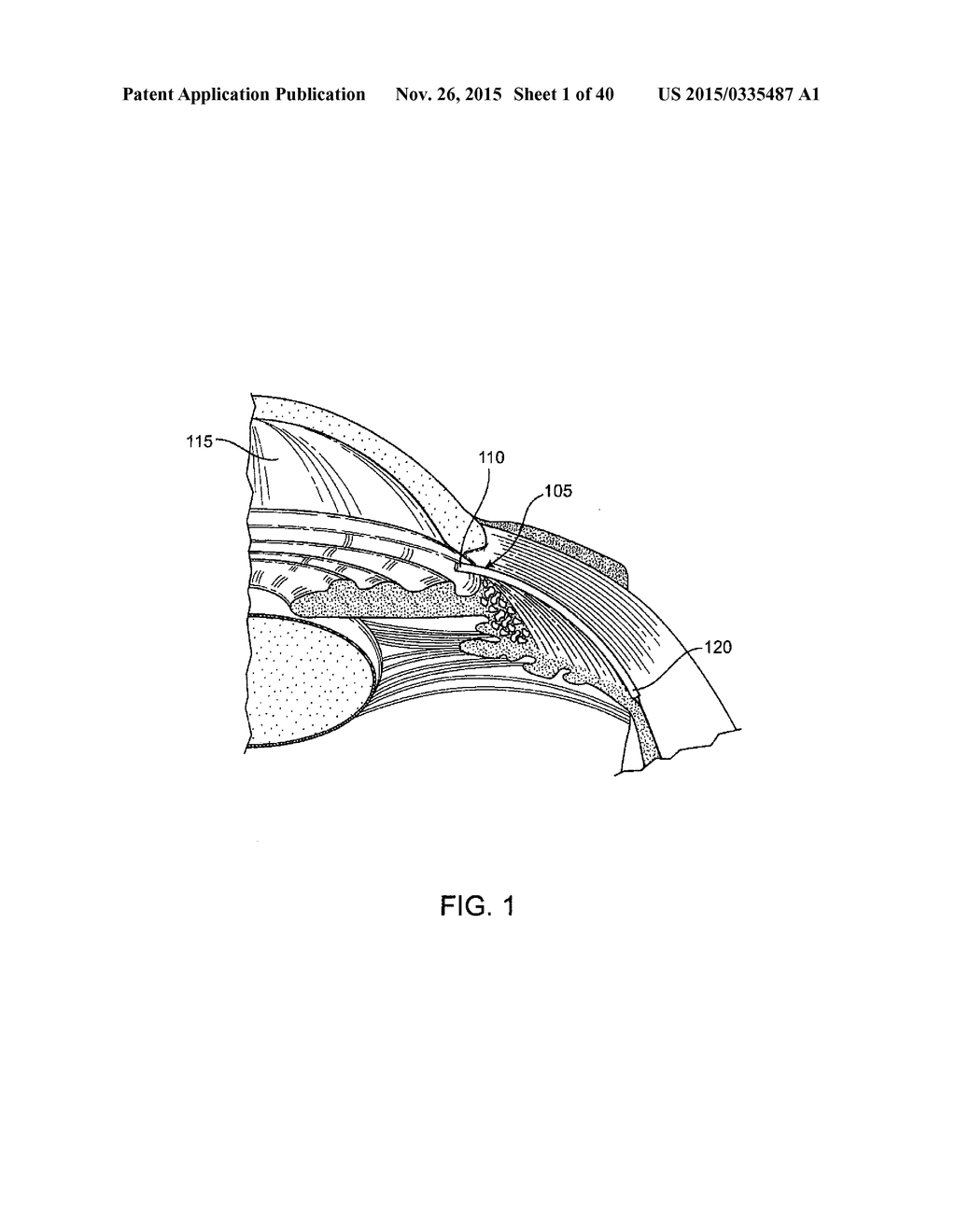 Glaucoma Treatment Device - diagram, schematic, and image 02