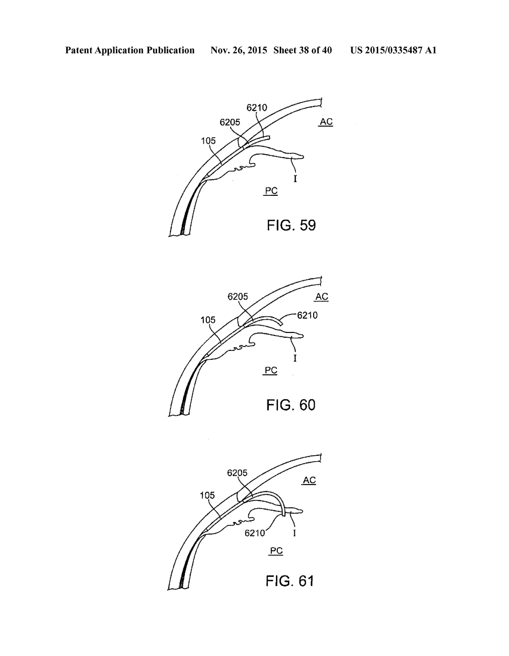 Glaucoma Treatment Device - diagram, schematic, and image 39