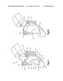 METHOD AND APPARATUS FOR CORRECTING AURICULAR DEFORMITIES diagram and image