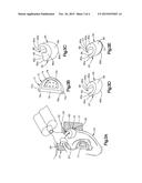 METHOD AND APPARATUS FOR CORRECTING AURICULAR DEFORMITIES diagram and image