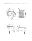 METHOD AND APPARATUS FOR CORRECTING AURICULAR DEFORMITIES diagram and image