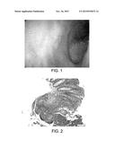 Treatment of Diseases Using Combination of Ultraviolet Blood Irradiation     and Antibiotics diagram and image