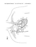 HEART ASSIST SYSTEM AND METHODS diagram and image