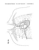 HEART ASSIST SYSTEM AND METHODS diagram and image