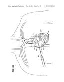 HEART ASSIST SYSTEM AND METHODS diagram and image