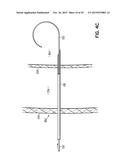 HEART ASSIST SYSTEM AND METHODS diagram and image