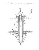 HEART ASSIST SYSTEM AND METHODS diagram and image