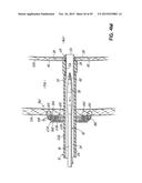 HEART ASSIST SYSTEM AND METHODS diagram and image