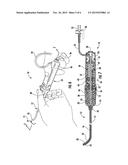 GUIDED INTRAVASCULAR CATHETER SHEATH HAVING BI-DIRECTIONAL STEERING     ASSEMBLY diagram and image