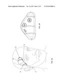 TRANSDERMAL NEUROSTIMULATOR ADAPTED TO REDUCE CAPACITIVE BUILD-UP diagram and image