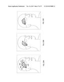 TRANSDERMAL NEUROSTIMULATOR ADAPTED TO REDUCE CAPACITIVE BUILD-UP diagram and image