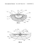 WOUND TREATMENT APPARATUS AND METHOD diagram and image