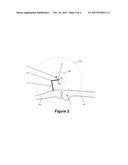 METHOD AND APPARATUS FOR DETECTING UNDESIRABLE ROTATION OF MEDICAL MARKERS diagram and image