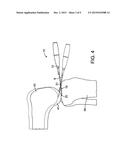 FORCE MEASURING JOINT DISTRACTION LEVER diagram and image