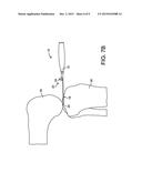 FORCE MEASURING JOINT DISTRACTION LEVER diagram and image