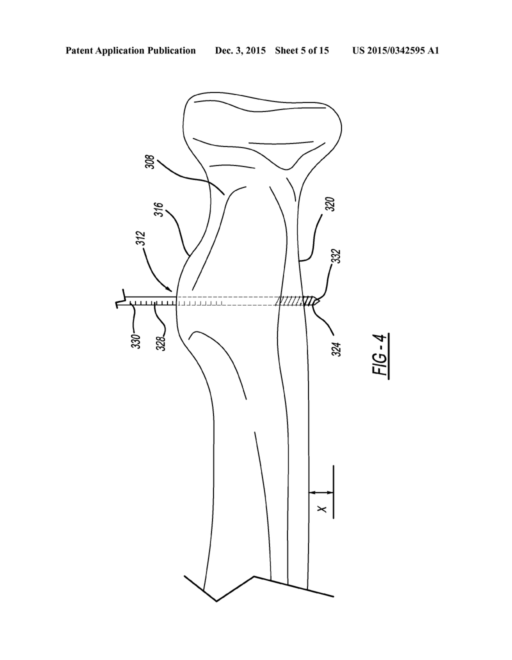 Insertion Tools and Method for Soft Anchor - diagram, schematic, and image 06