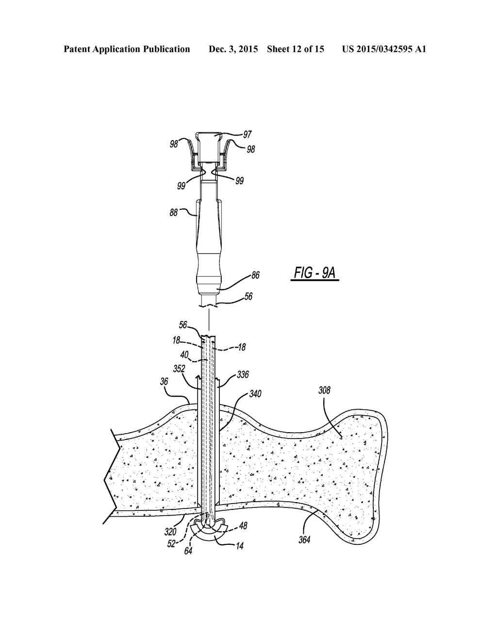 Insertion Tools and Method for Soft Anchor - diagram, schematic, and image 13