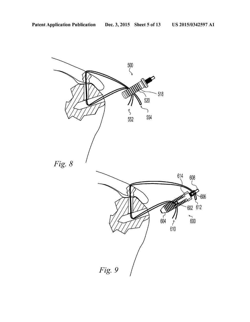 Suture Anchor - diagram, schematic, and image 06