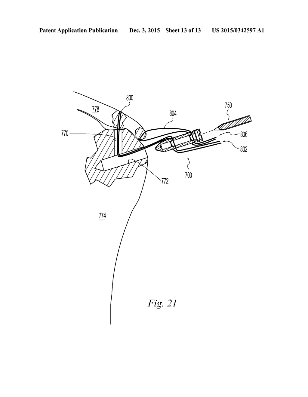 Suture Anchor - diagram, schematic, and image 14