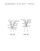 MEDICAL DEVICES AND METHODS FOR LUNG VOLUME REDUCTION diagram and image