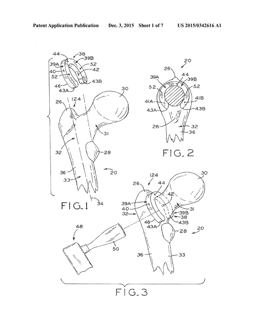 PATIENT-SPECIFIC INSTRUMENTS FOR TOTAL HIP ARTHROPLASTY - diagram, schematic, and image 02