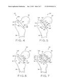 PATIENT-SPECIFIC INSTRUMENTS FOR TOTAL HIP ARTHROPLASTY diagram and image