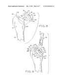 PATIENT-SPECIFIC INSTRUMENTS FOR TOTAL HIP ARTHROPLASTY diagram and image