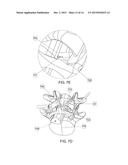 TISSUE REMOVAL DEVICE diagram and image