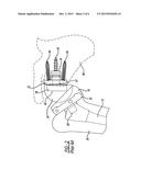 Patient-Specific Glenoid Depth Control diagram and image