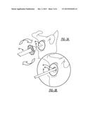 Patient-Specific Glenoid Depth Control diagram and image