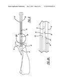 Patient-Specific Glenoid Depth Control diagram and image