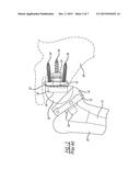 Patient-Specific Glenoid Depth Control diagram and image