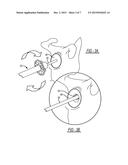 Patient-Specific Glenoid Depth Control diagram and image