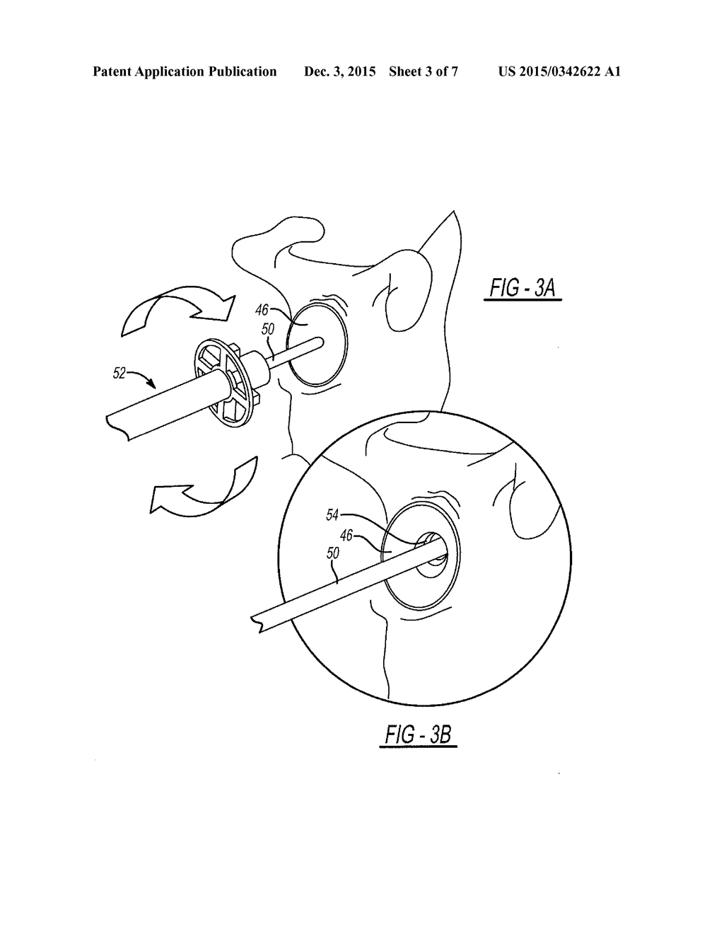 Patient-Specific Glenoid Depth Control - diagram, schematic, and image 04