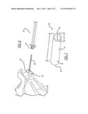 Patient-Specific Glenoid Depth Control diagram and image