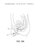 LOCKING MEMBER FOR A MEDICAL ASSEMBLY DELIVERY DEVICE diagram and image