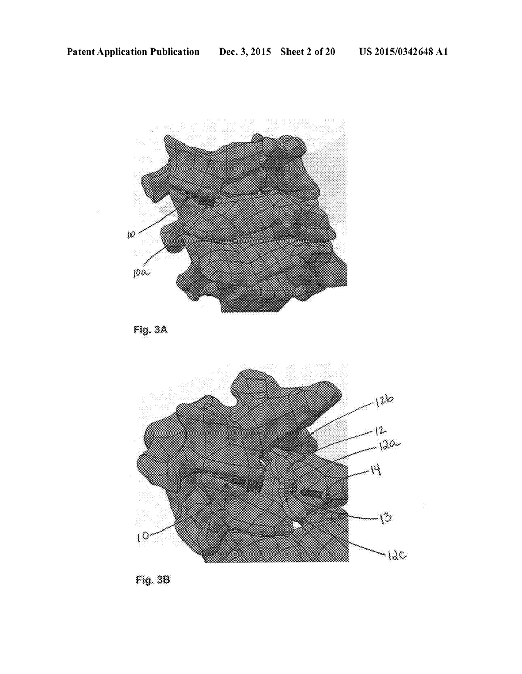 LATERAL MASS FIXATION IMPLANT - diagram, schematic, and image 03