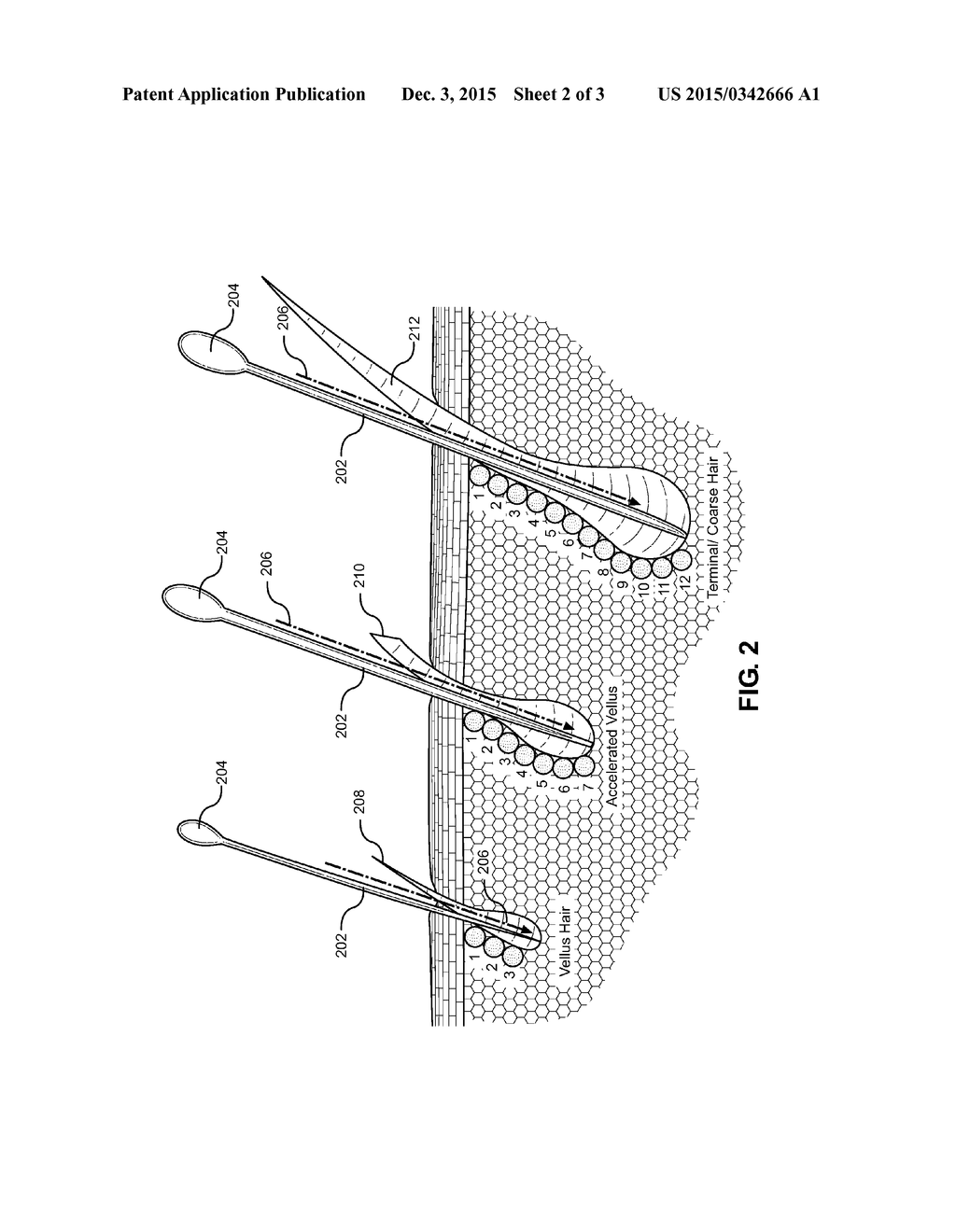 Epilation by Thermolysis - diagram, schematic, and image 03