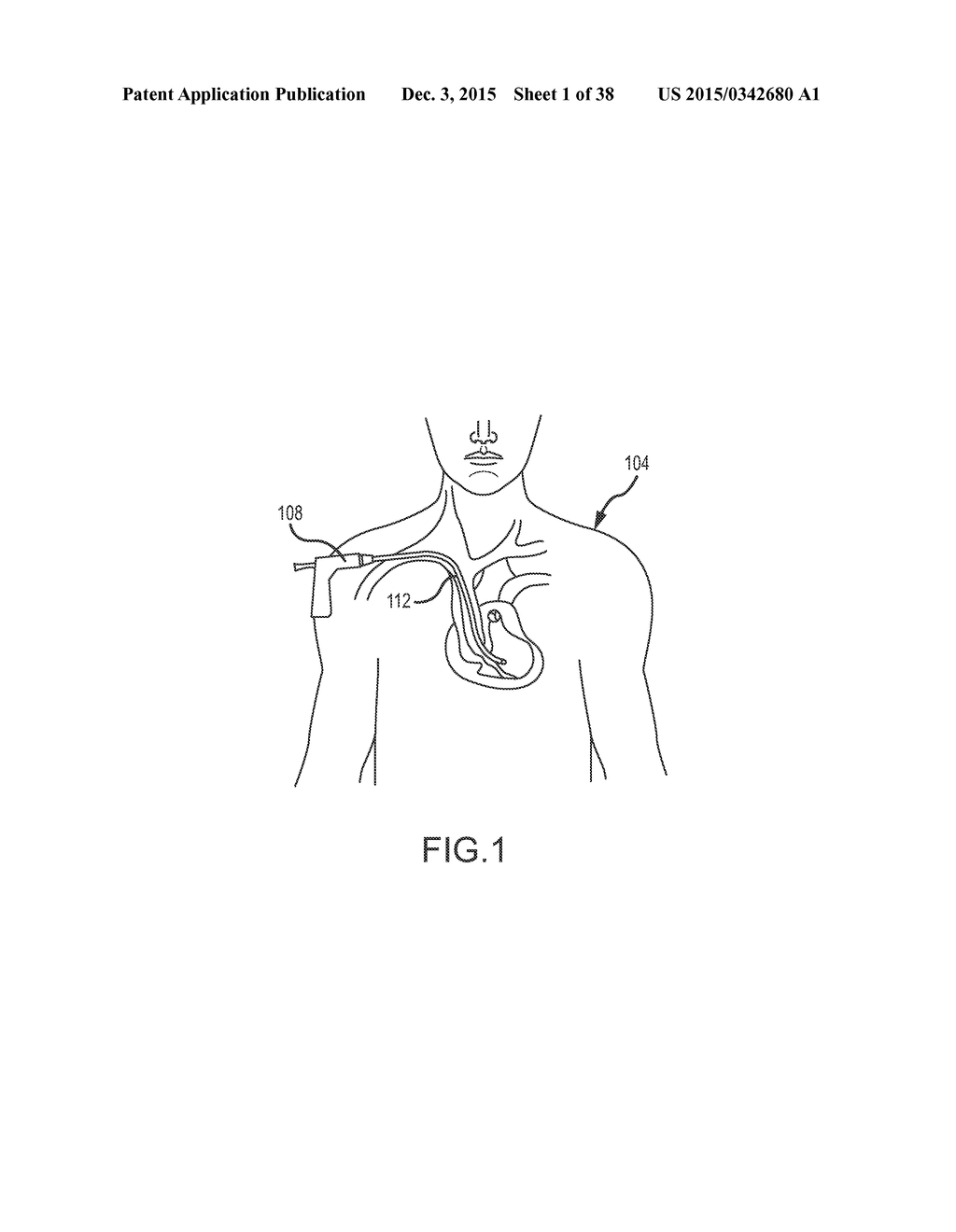 SURGICAL INSTRUMENT FOR REMOVING AN IMPLANTED OBJECT - diagram, schematic, and image 02