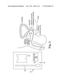 SURGICAL SYSTEM FOR AND A METHOD OF IDENTIFYING AN INCISION SITE diagram and image