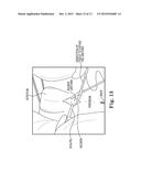 SURGICAL SYSTEM FOR AND A METHOD OF IDENTIFYING AN INCISION SITE diagram and image